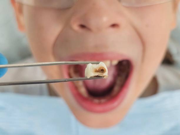 Best Emergency Tooth Extraction in New Richmond, WI